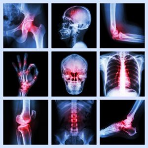 Chronic Pain with an Aging Workforce